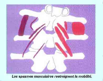 La Subluxation