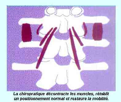 L'Absence de Subluxation